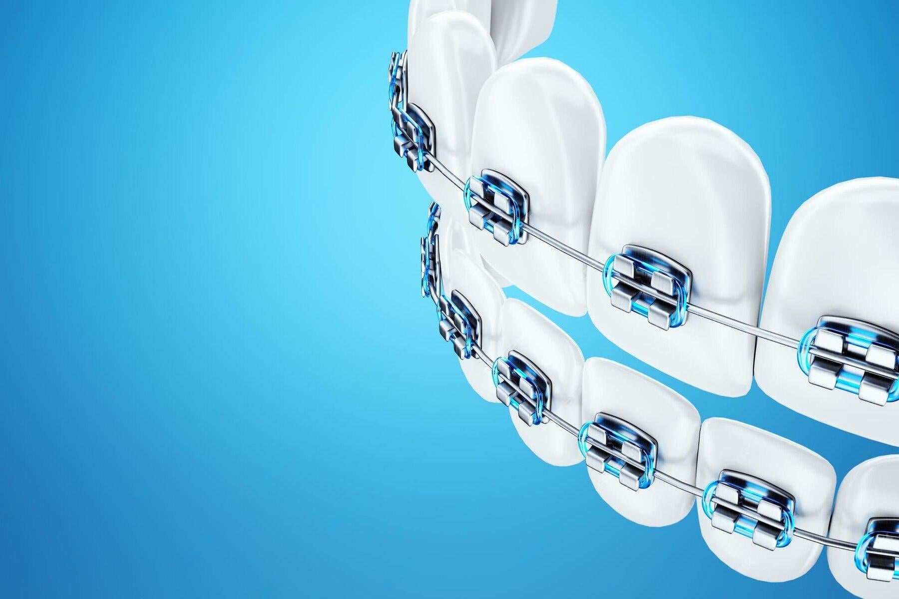 How Should Patients with Braces Properly Brush Their Teeth?